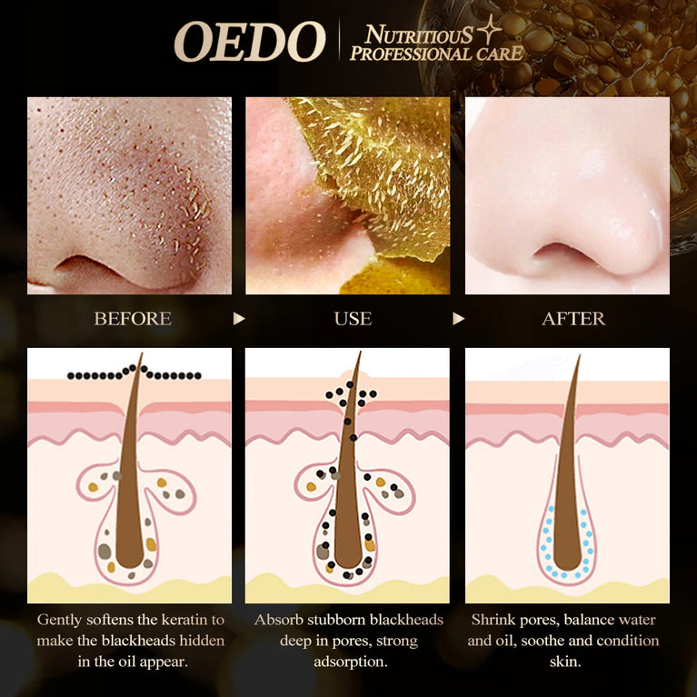 🖤OEDO -Blackhead Removal Mask – Deep Pore Cleansing, Acne Control & Skin Purifying 🖤
