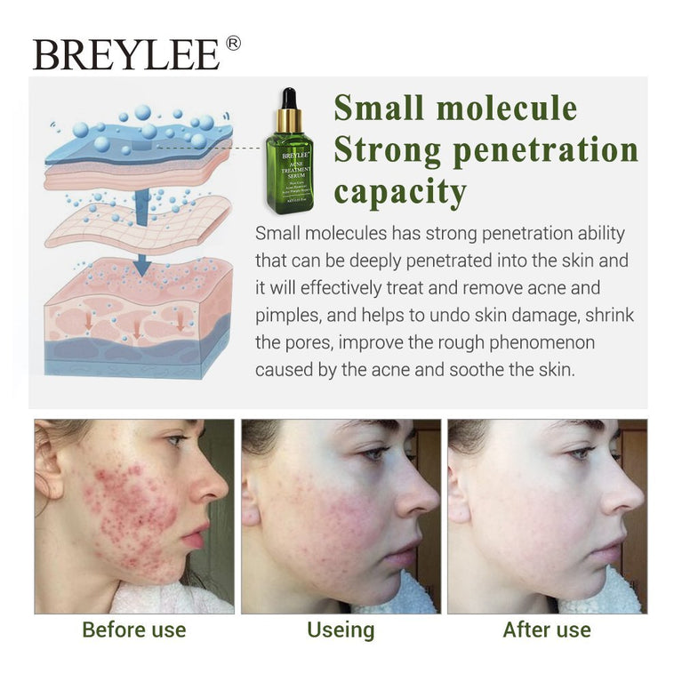 BREYLEE Acne Treatment Serum – Clears Pimples, Scars & Brightens Skin