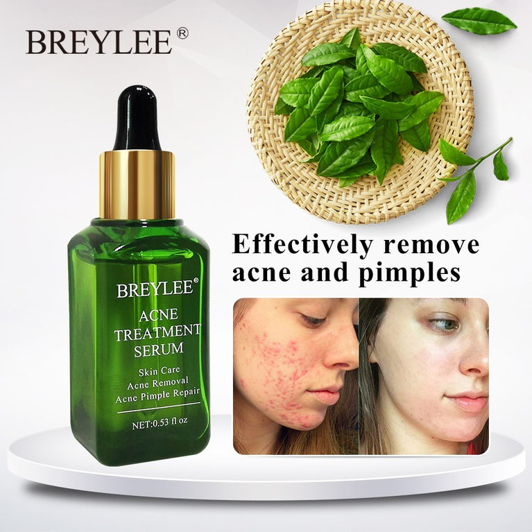 BREYLEE Acne Treatment Serum – Clears Pimples, Scars & Brightens Skin