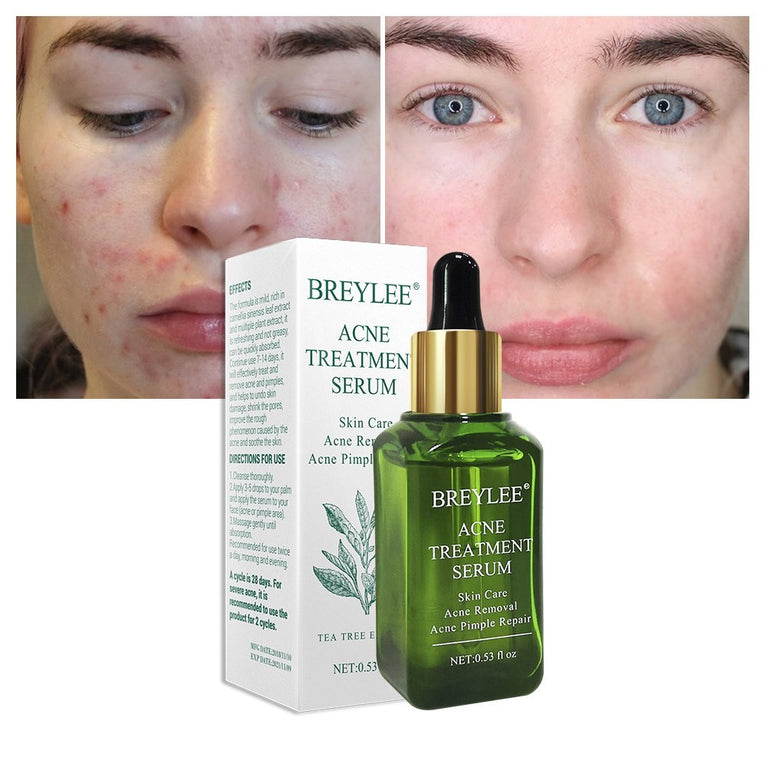 BREYLEE Acne Treatment Serum – Clears Pimples, Scars & Brightens Skin